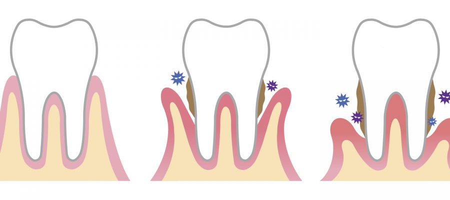 periodontal disease affect the bone that surrounds and supports teeth. plaque build up and the bacteria infect not only your gums and teeth, but eventually the bone that support the teeth.